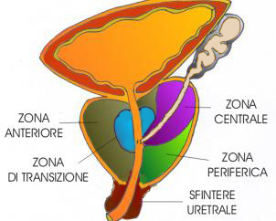 Prostata ingrossata intervento